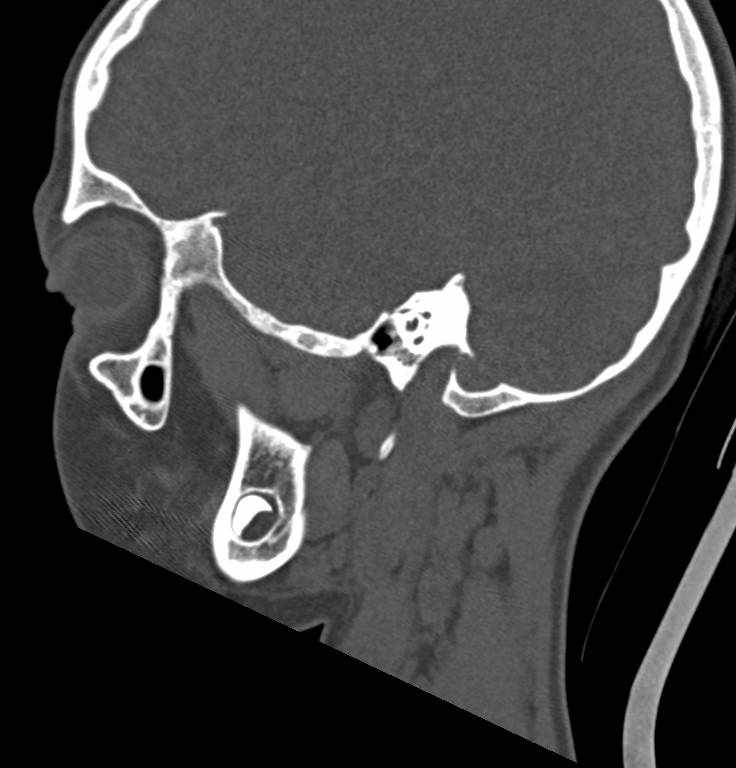 Cerebellar abscess (Radiopaedia 73727-84527 Sagittal bone window 13).jpg