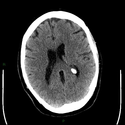 Cerebellar abscess (Radiopaedia 78135-90671 Axial non-contrast 64).jpg