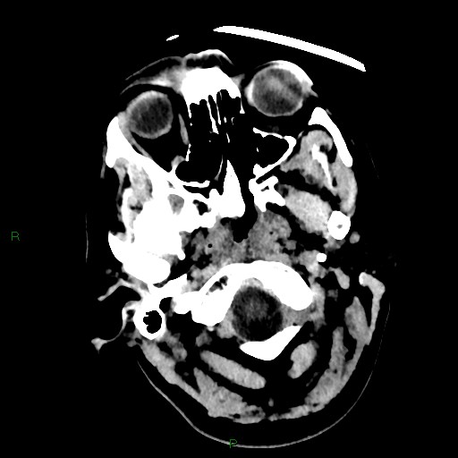 Cerebellar abscess (Radiopaedia 78135-90671 Axial non-contrast 8).jpg