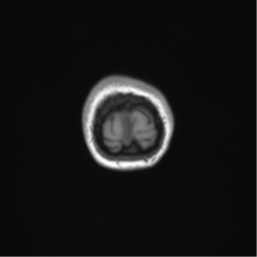 Cerebellar agenesis with hypoplastic pons (pontocerebellar hypoplasia) (Radiopaedia 57224-64138 Coronal T1 5).png
