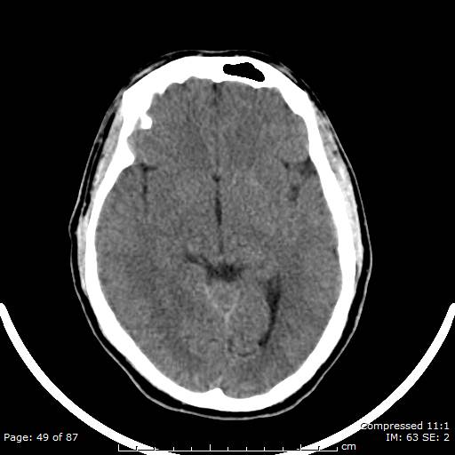Cerebellar hemangioblastoma (Radiopaedia 52360-58258 Axial non-contrast 49).jpg