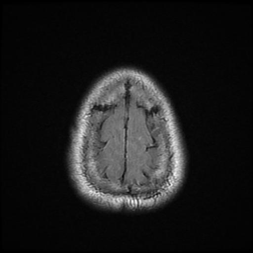 File:Cerebellar hemangioblastoma (Radiopaedia 88055-104622 Axial FLAIR 23).jpg