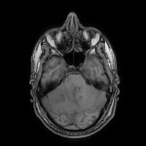 File:Cerebellar hemangioblastoma (Radiopaedia 88055-104622 Axial T1 13).jpg