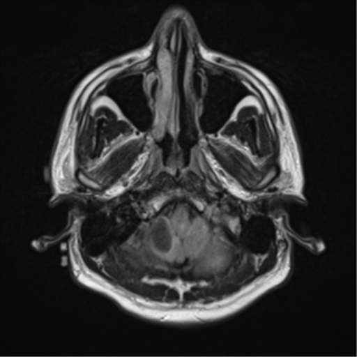 File:Cerebellar hemangioblastomas and pituitary adenoma (Radiopaedia 85490-101176 Axial FLAIR 4).png
