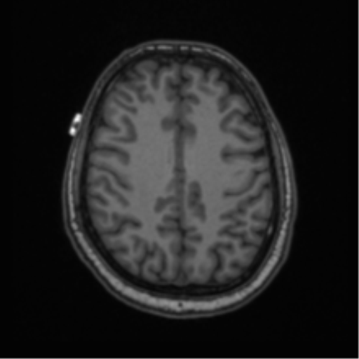 Cerebellar hemangioblastomas and pituitary adenoma (Radiopaedia 85490-101176 Axial T1 52).png