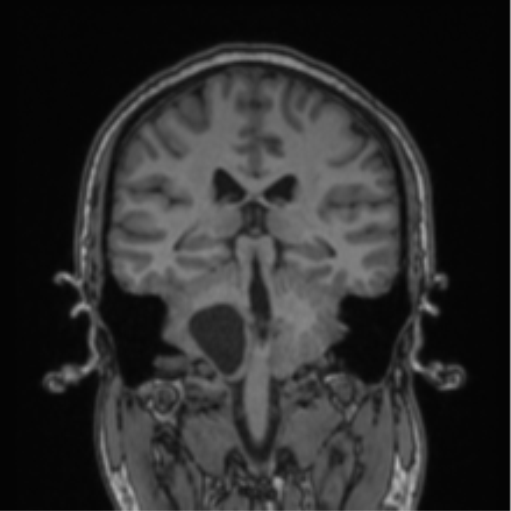 Cerebellar hemangioblastomas and pituitary adenoma (Radiopaedia 85490-101176 Coronal T1 40).png