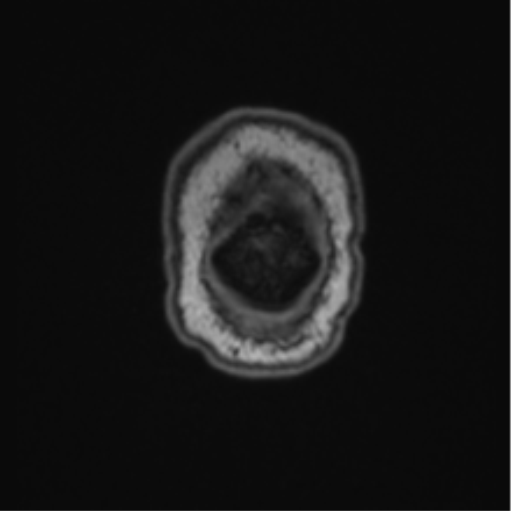 File:Cerebellar hemangioblastomas and pituitary adenoma (Radiopaedia 85490-101176 Coronal T1 7).png