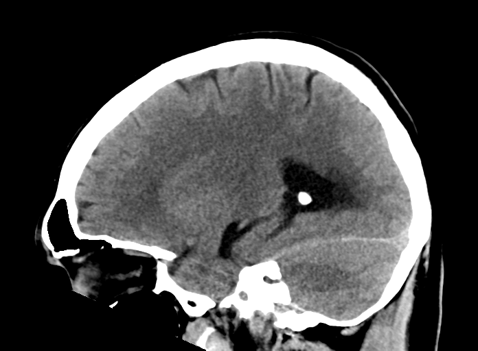 File:Cerebellar hemorrhage (Radiopaedia 37000-38671 A 23).png