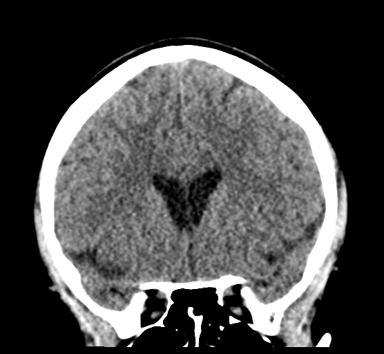 Cerebellar metastases - colorectal adenocarcinoma (Radiopaedia 40947-43652 Coronal non-contrast 37).png