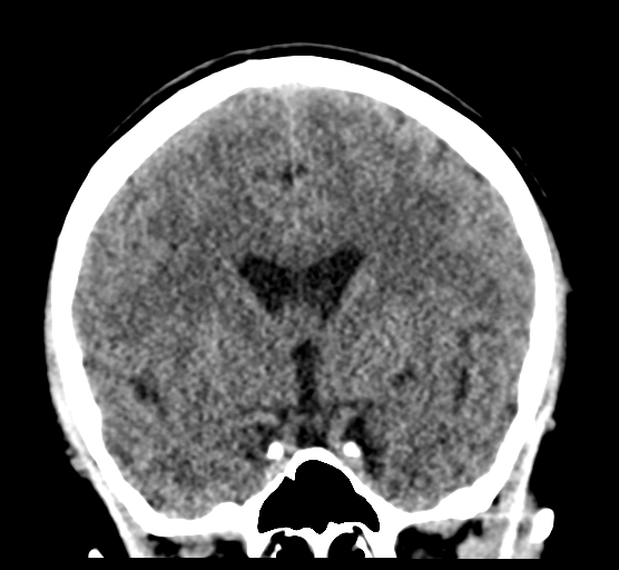 Cerebellar metastases - colorectal adenocarcinoma (Radiopaedia 40947-43652 Coronal non-contrast 44).png