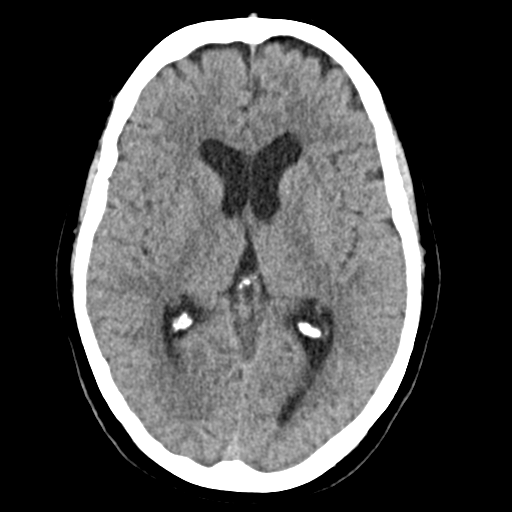 Cerebellar metastasis (Radiopaedia 54578-60812 Axial non-contrast 25).png