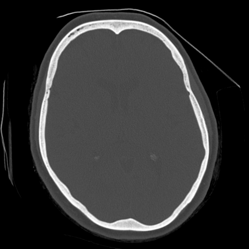 File:Cerebellar metastasis (cystic appearance) (Radiopaedia 41395-44258 Axial bone window 37).png
