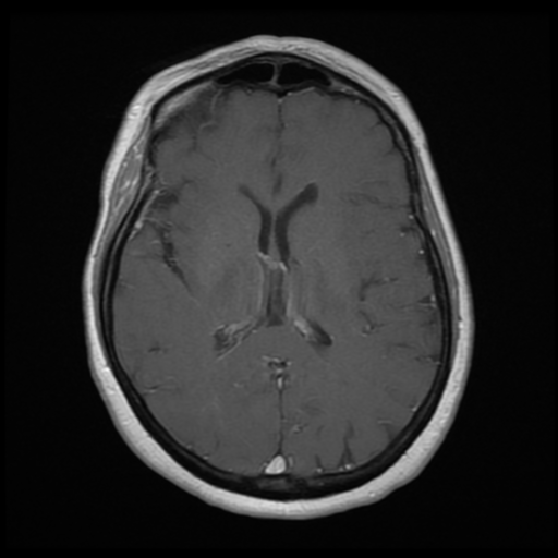 File:Cerebellar metastasis (cystic appearance) (Radiopaedia 41395-44268 Axial T1 C+ 13).png