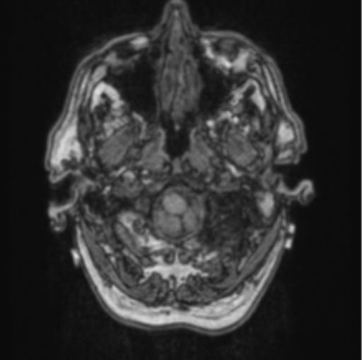 File:Cerebellar metastasis from lung adenocarcinoma (Radiopaedia 86690-102829 Axial T1 12).png