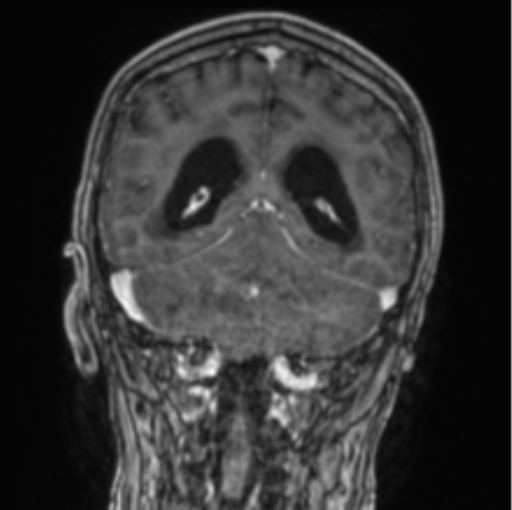 File:Cerebellar metastasis from lung adenocarcinoma (Radiopaedia 86690-102829 Coronal T1 C+ 37).png