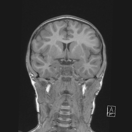 Cerebellar stroke (Radiopaedia 32202-33150 Coronal T1 26).png
