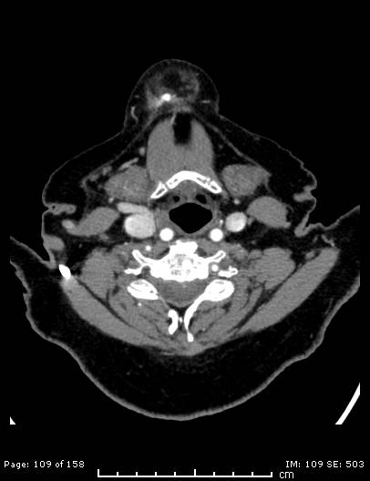 File:Cerebellar strokes due to intracranial giant cell arteritis (Radiopaedia 68799-78510 CT angiogram 109).jpg