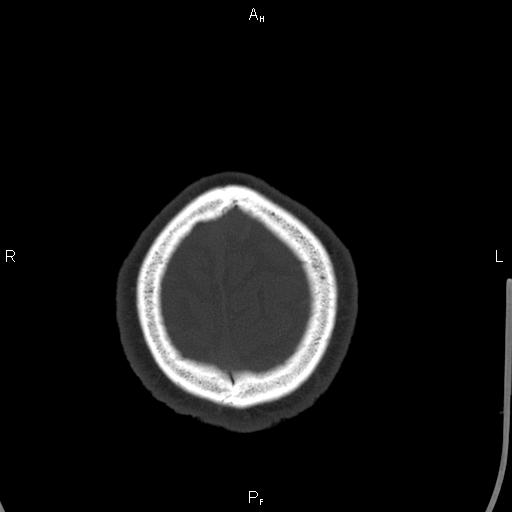 Cerebellopontine angle arachnoid cyst (Radiopaedia 85149-100704 Axial bone window 50).jpg