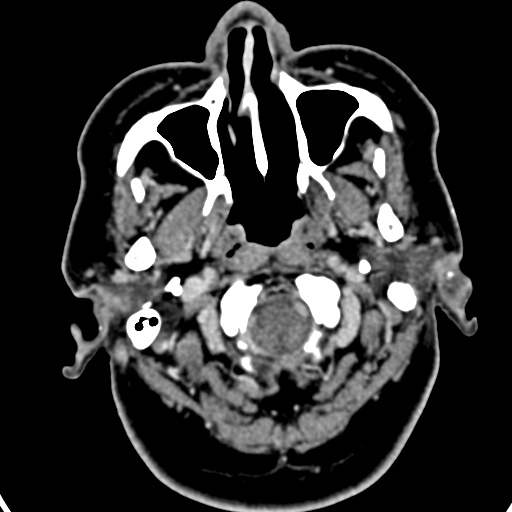 Cerebellopontine angle meningioma (Radiopaedia 35181-36714 A 59).jpg