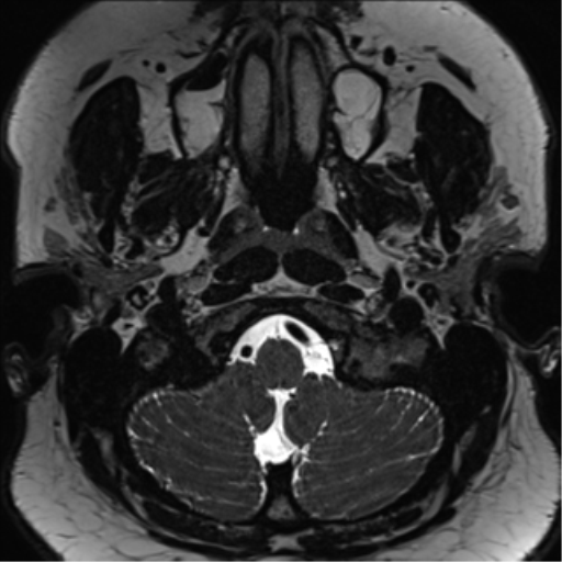 Cerebellopontine angle meningioma (Radiopaedia 48434-53348 Axial T2 Space 12).png