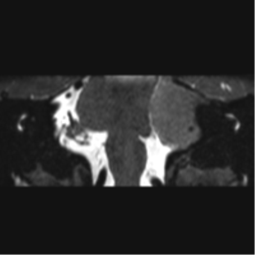 Cerebellopontine angle meningioma (Radiopaedia 48434-53348 Coronal T2 42).png