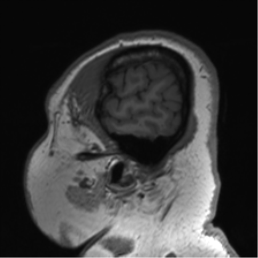 Cerebellopontine angle meningioma (Radiopaedia 48434-53348 Sagittal T1 80).png