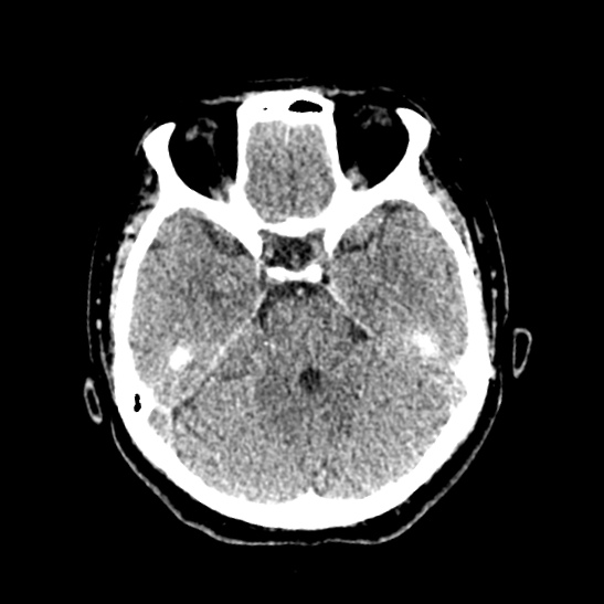 Cerebellopontine angle meningioma (Radiopaedia 53561-59592 Axial non-contrast 22).jpg
