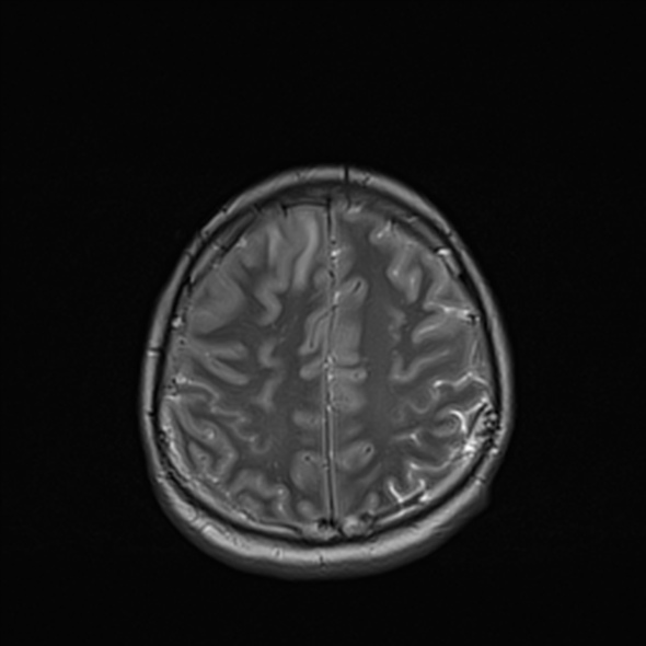 Cerebral abscess (Radiopaedia 24212-24478 Axial T2 47).jpg