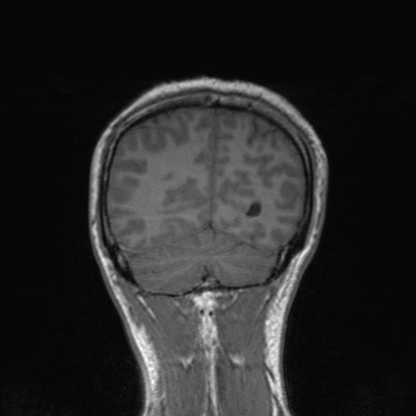 Cerebral abscess (Radiopaedia 24212-24478 Coronal T1 163).jpg