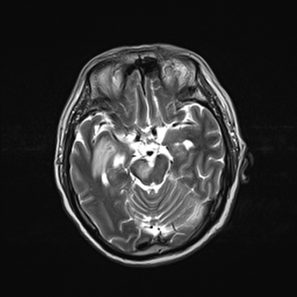 Cerebral abscess (Radiopaedia 26111-26247 Axial T2 26).jpg