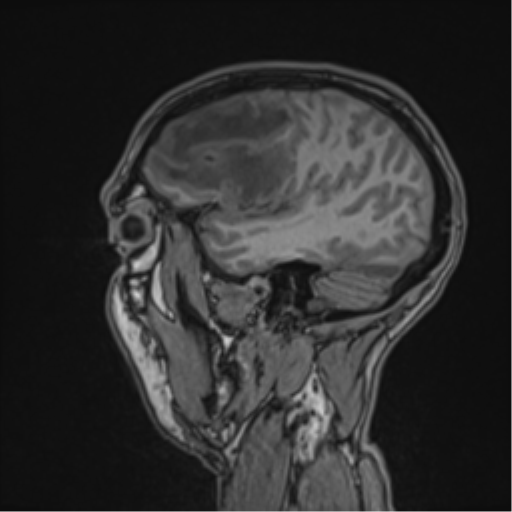 Cerebral abscess (Radiopaedia 60342-68009 Sagittal T1 44).png