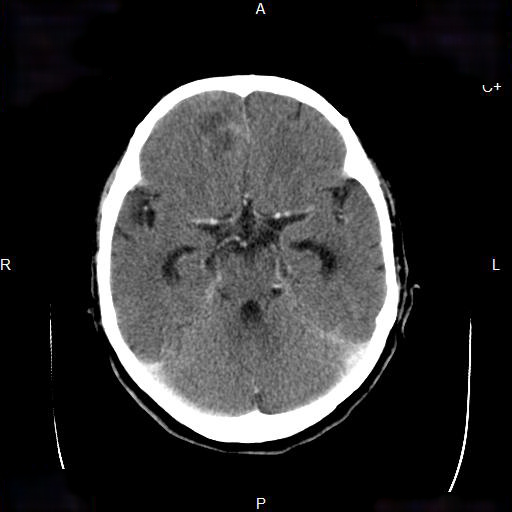 File:Cerebral abscess (Radiopaedia 7606-8432 Axial C+ delayed 6).jpg