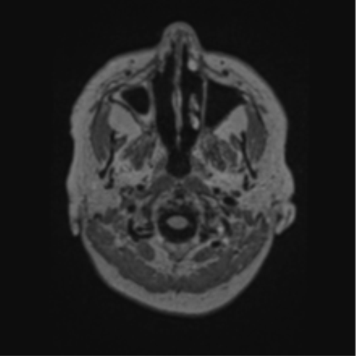 Cerebral abscess from pulmonary arteriovenous malformation (Radiopaedia 86275-102291 J 5).png
