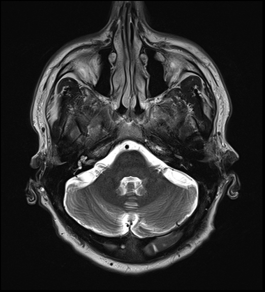 File:Cerebral abscess with ventriculitis (Radiopaedia 78965-91878 Axial T2 11).jpg