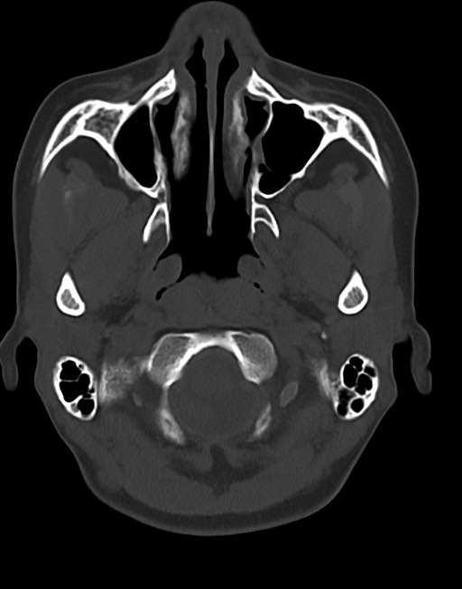 Cerebral abscesses (Radiopaedia 70458-80568 Axial bone window 11).jpg