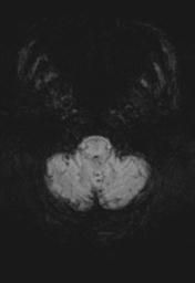 File:Cerebral amyloid angiopathy (Radiopaedia 29129-29518 Axial SWI MIP 3).jpg