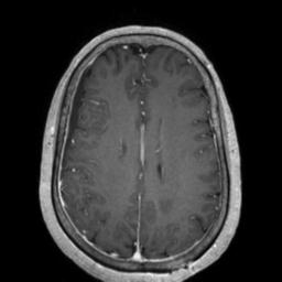File:Cerebral amyloid angiopathy (Radiopaedia 29129-29518 Axial T1 C+ 98).jpg