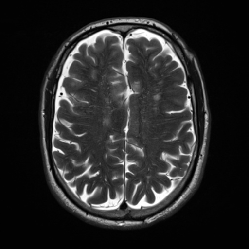 File:Cerebral amyloid angiopathy (Radiopaedia 46082-50433 Axial T2 25).png