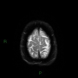 Cerebral amyloid angiopathy (Radiopaedia 77506-89664 Axial DWI 54).jpg