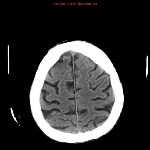 File:Cerebral and orbital tuberculomas (Radiopaedia 13308-13310 Axial non-contrast 23).jpg