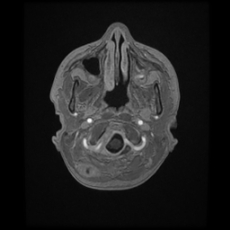 Cerebral and spinal tuberculosis (Radiopaedia 90489-107837 Axial T1 C+ 28).jpg