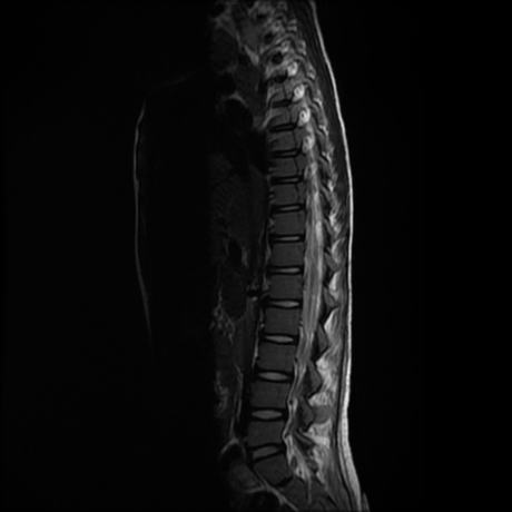 File:Cerebral and spinal tuberculosis (Radiopaedia 90489-107912 Sagittal T2 8).jpg