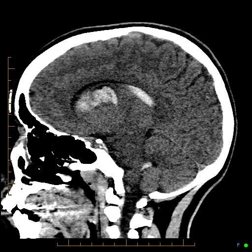 Cerebral arteriovenous malformation (AVM) (Radiopaedia 78162-90706 A 35).jpg