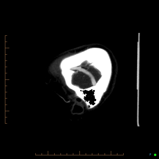 Cerebral arteriovenous malformation (AVM) (Radiopaedia 78162-90706 Sagittal CTA 9).jpg