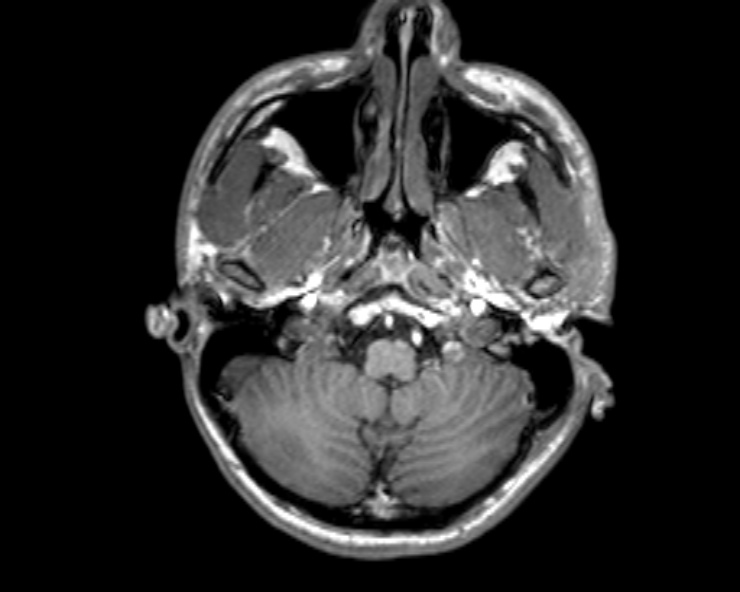 Cerebral arteriovenous malformation (Radiopaedia 30198-30813 Axial T1 48).jpg