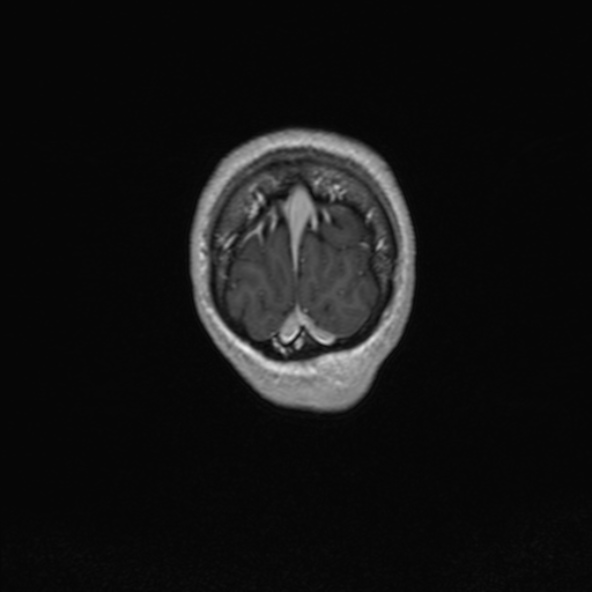 Cerebral arteriovenous malformation (Radiopaedia 30198-30813 F 55).jpg