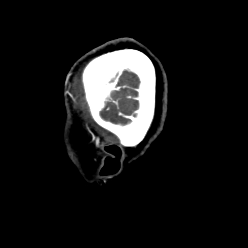 Cerebral arteriovenous malformation (Radiopaedia 73830-84645 Sagittal C+ delayed 4).jpg