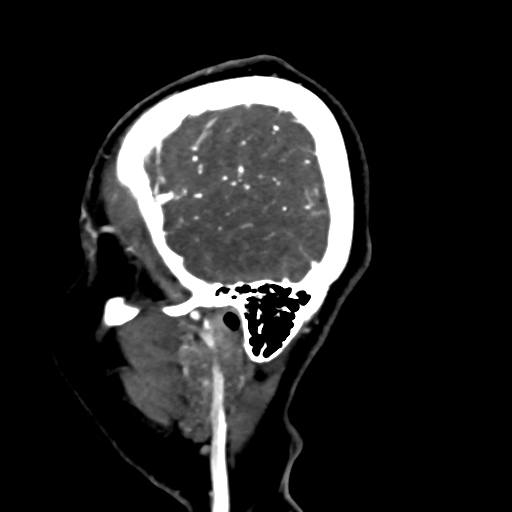 Cerebral arteriovenous malformation (Radiopaedia 73830-84645 Sagittal C+ delayed 81).jpg