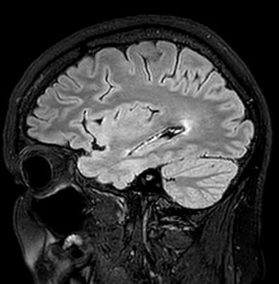 Cerebral arteriovenous malformation (Radiopaedia 74411-85746 Sagittal FLAIR 29).jpg
