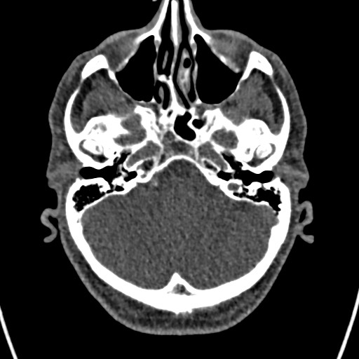 Cerebral arteriovenous malformation (Radiopaedia 78188-90746 Axial non-contrast 37).jpg